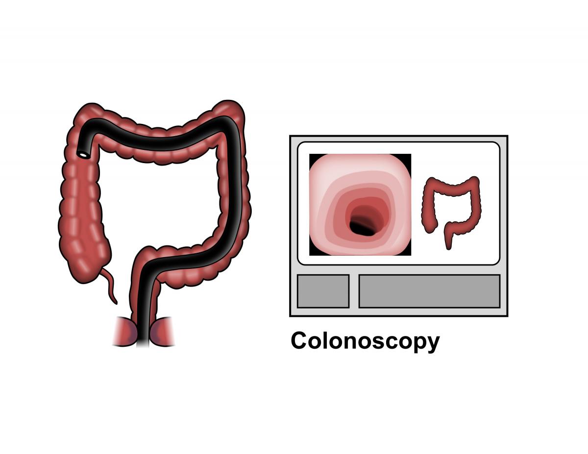 Polyps of the Colon and Rectum ASCRS