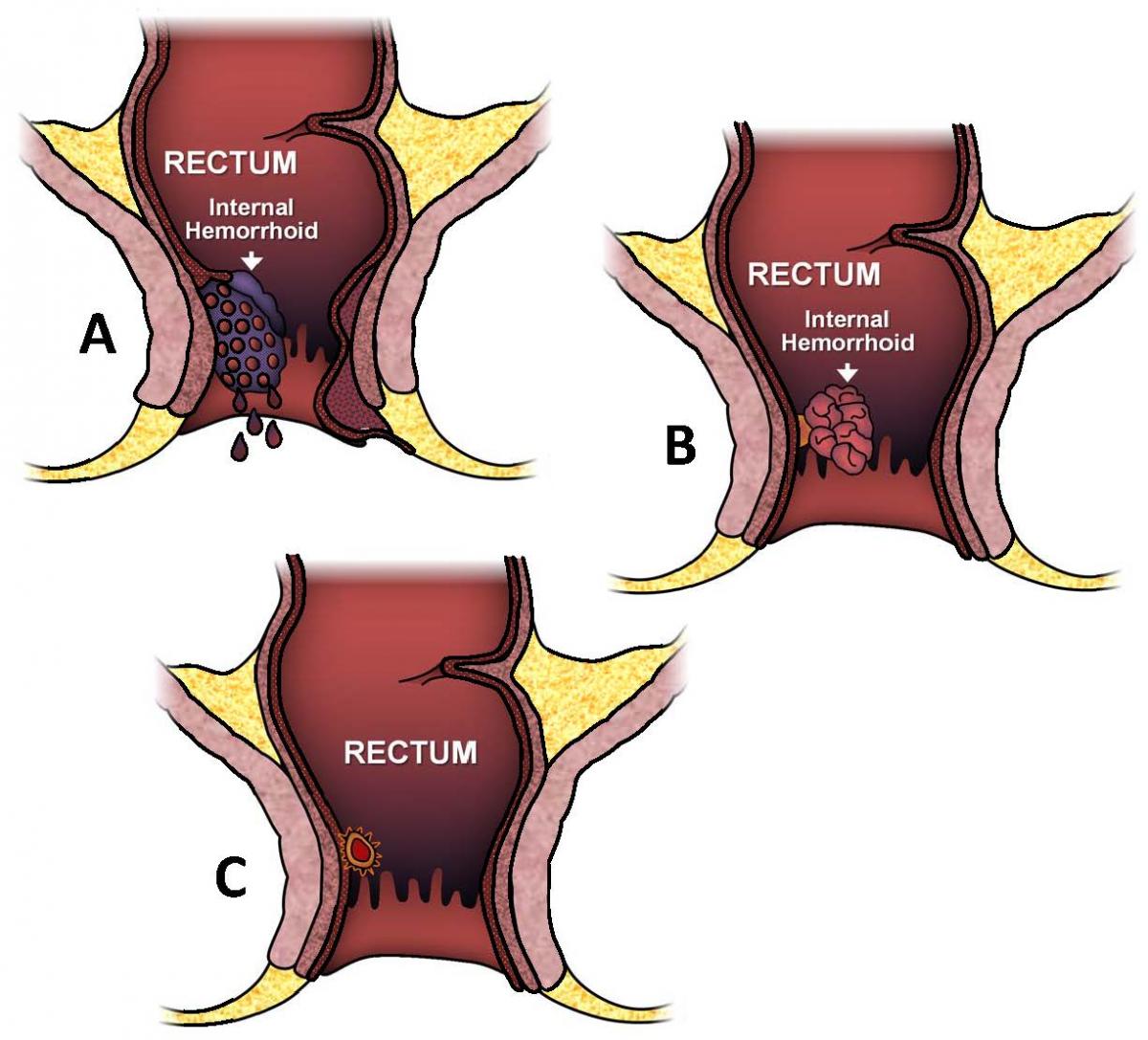 Hemorrhoids ASCRS