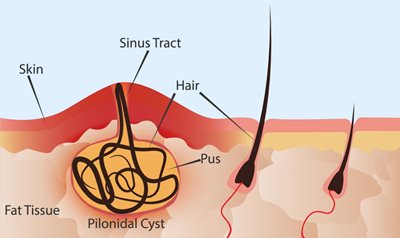 Pilonidal disease - Wikipedia