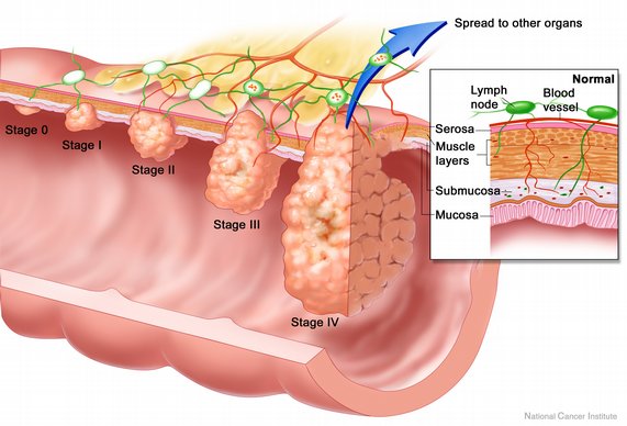 Rectal Prolapse Expanded Version